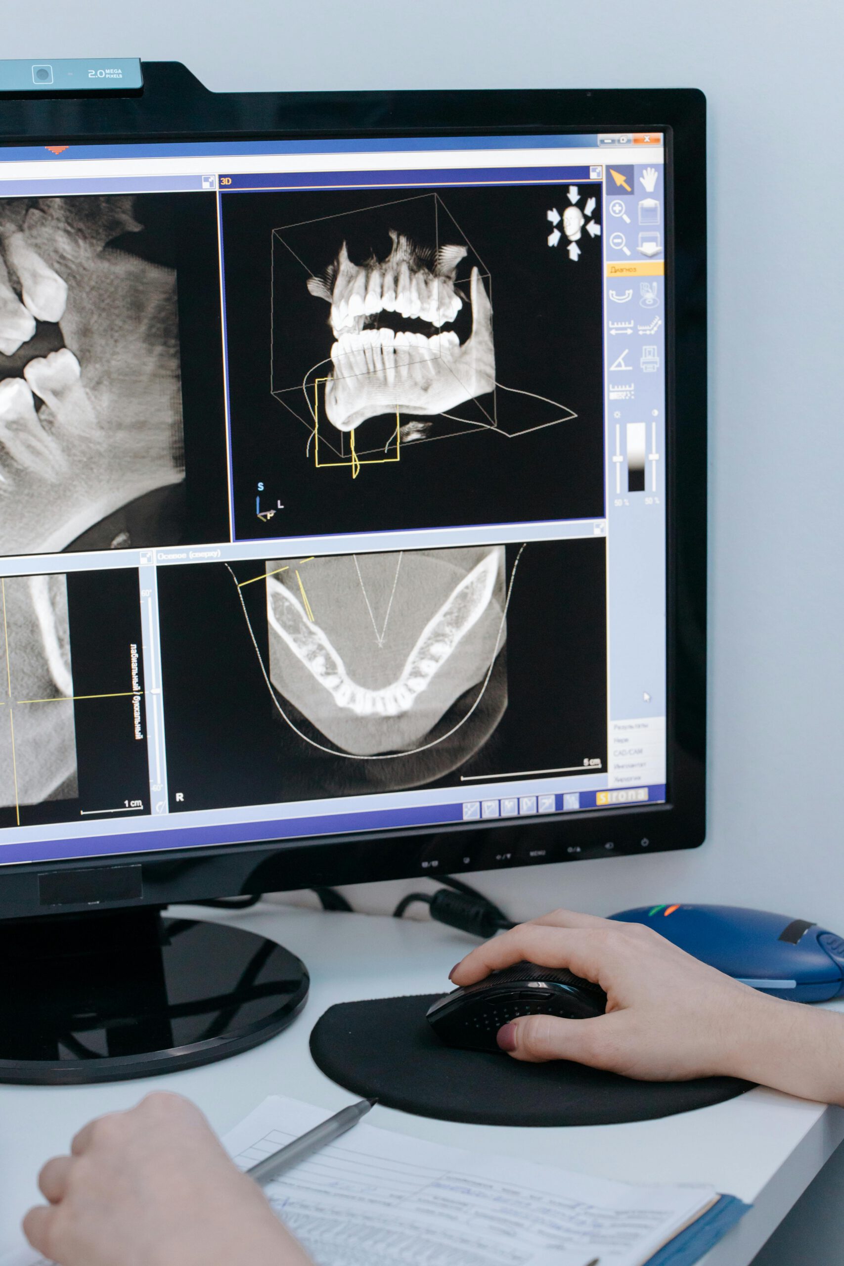 Close-up of dental X-ray images displayed on a computer screen for analysis.